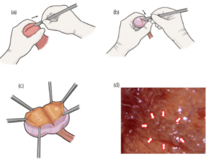 Clinical management of nonobstructive azoospermia: An update