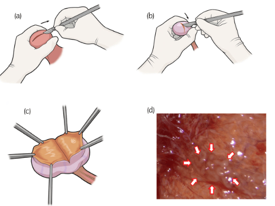 Nonobstructive Azoospermia Treatment